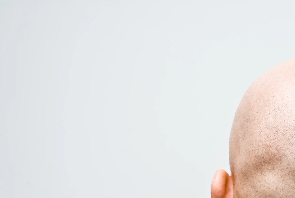 Calling a man 'bald' can be considered sexual harassment, High Court rules