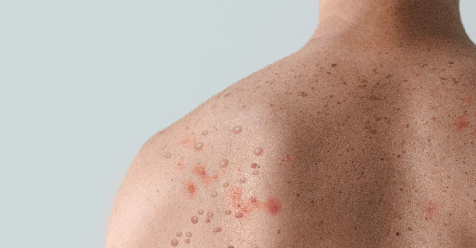 Monkeypox patient reveals how his lesions gradually worsened in daily selfies